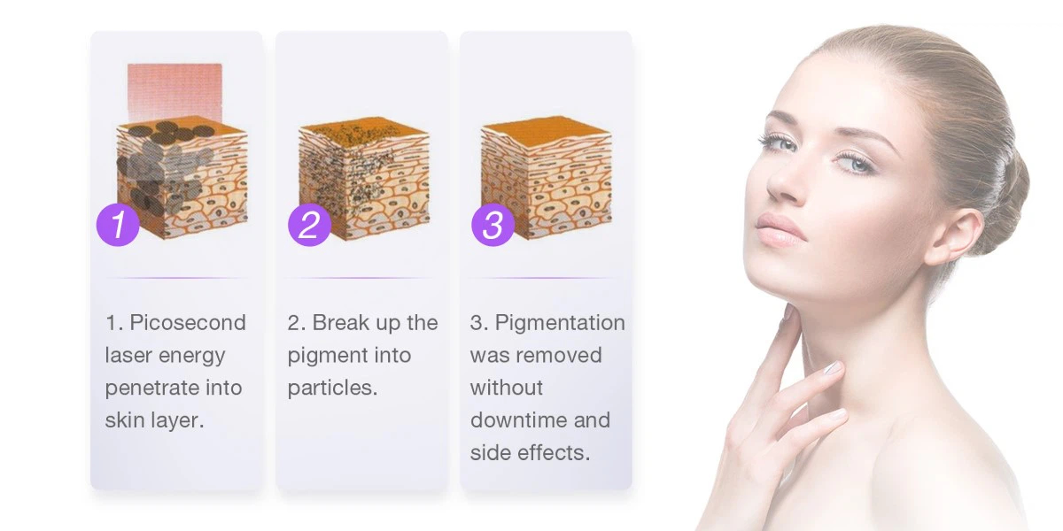 How Does the Picosecond Laser Work