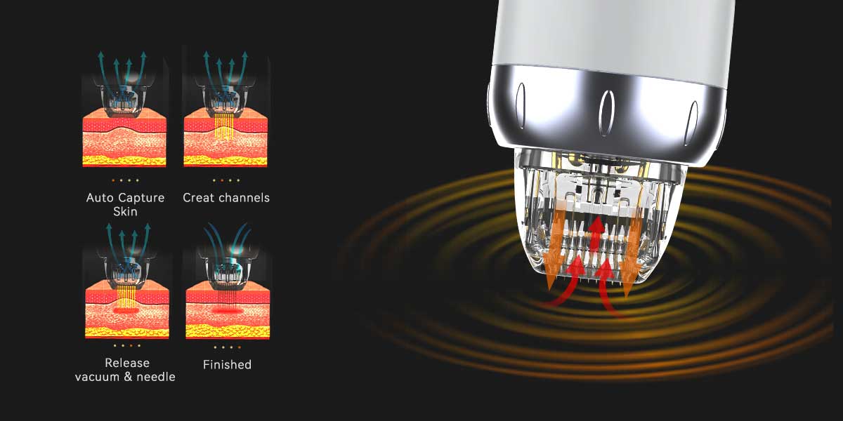 Profound Rf Machine of China