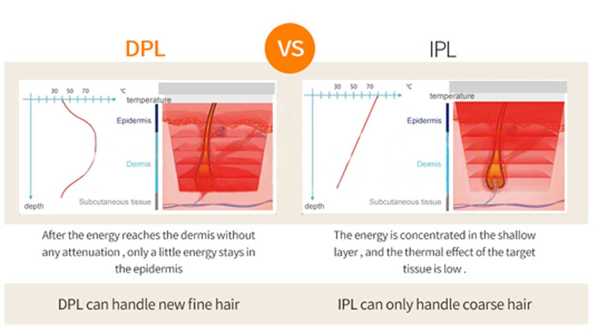 DPL Hair Removal of Company