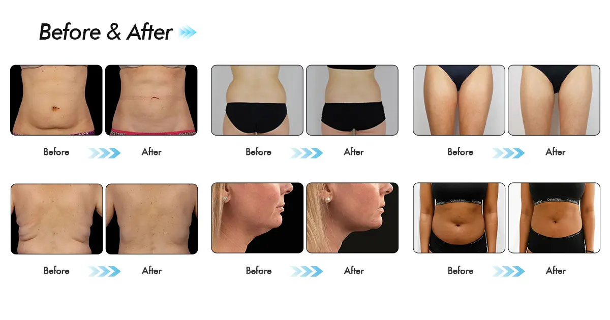 CoolSculpting πάνω όπλα: πριν και μετά φωτογραφίες