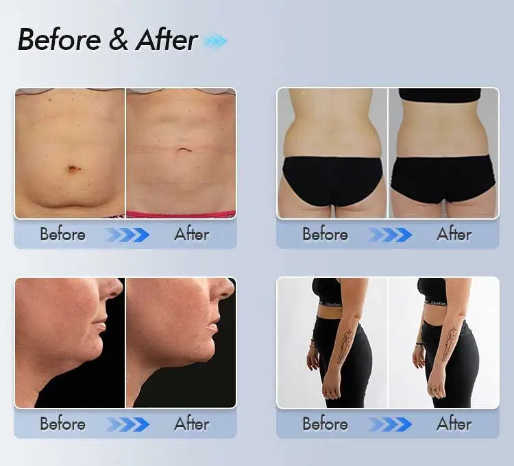 Από διπλό κερί σε καθορισμένη Jawline: CoolSculpting πριν και μετά.