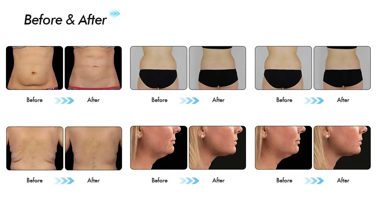 CoolSculpting αποτελεσματικότητα: Οπτικές αλλαγές μετά από 1, 2, και 3 εβδομάδες