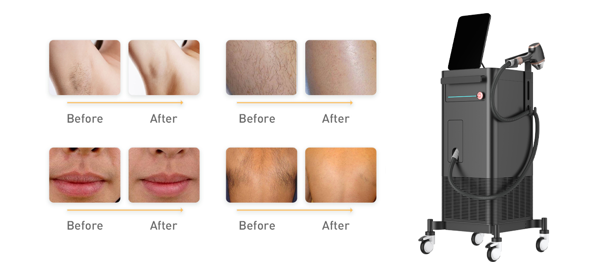 Ποια μέθοδος αφαίρεσης των μαλλιών λέιζερ είναι καλύτερη;