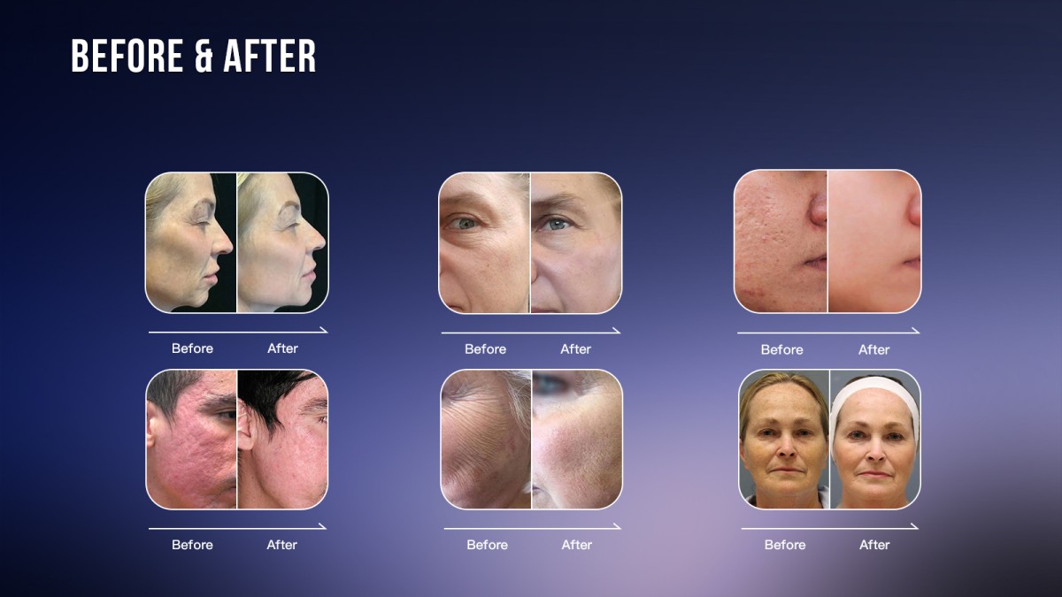 The-Before-and-After-Show-of-2940nm-Erbium-YAG-Laser-Machine